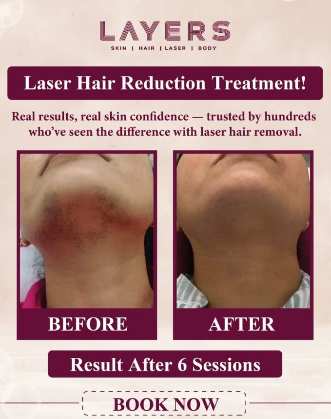 Permanent Hair Removal